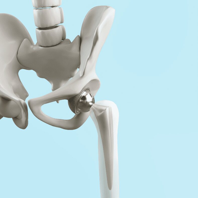 cartoon skeleton showing where composites are places during hip replacements and surgeries