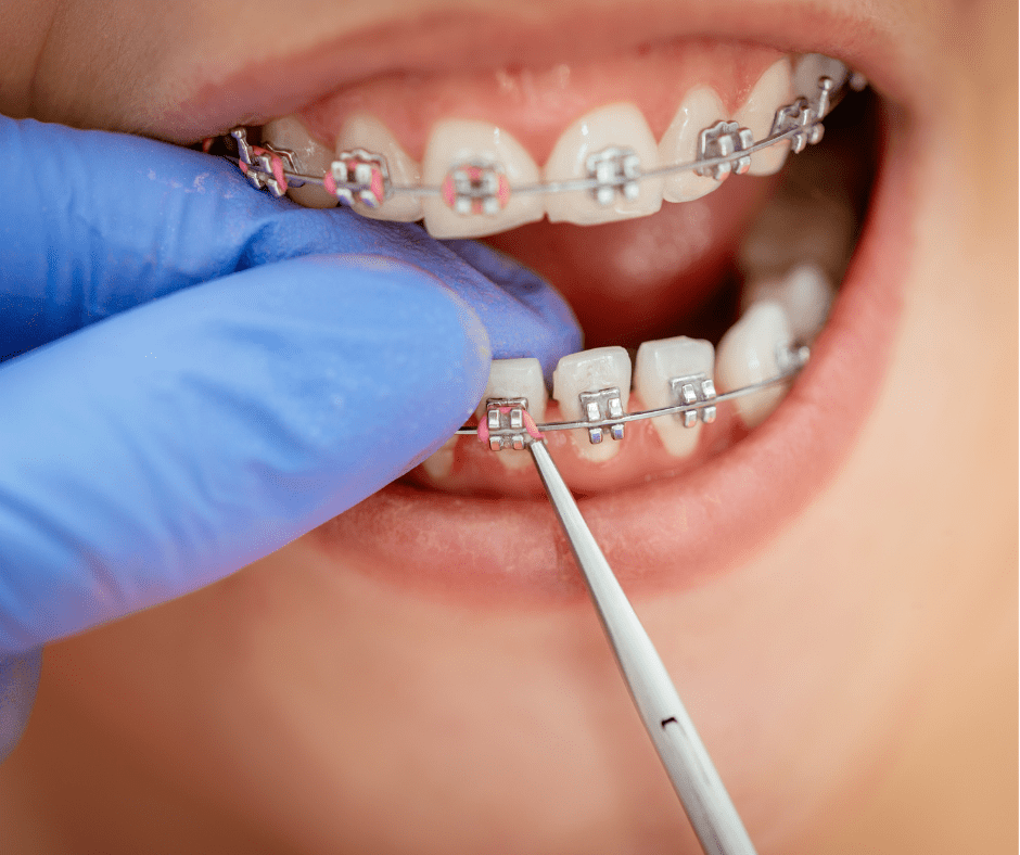 braces being applied on patient by dentist using precision equipment 